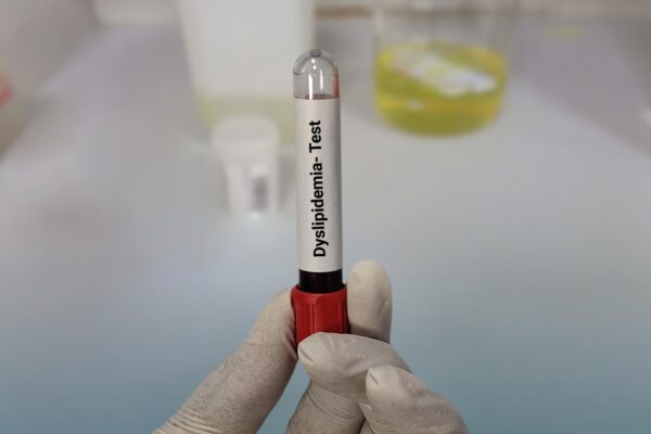 Lipoproteina(a): când poate fi utilă măsurarea